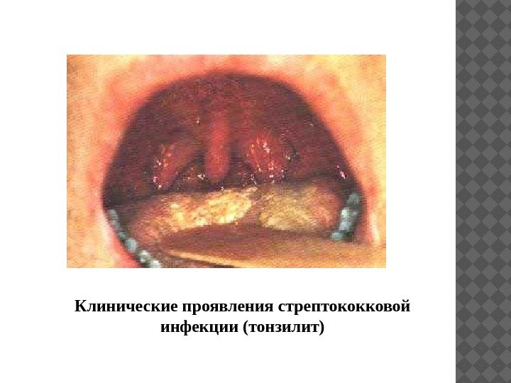 Клинические проявления стрептококковой инфекции (тонзилит) 