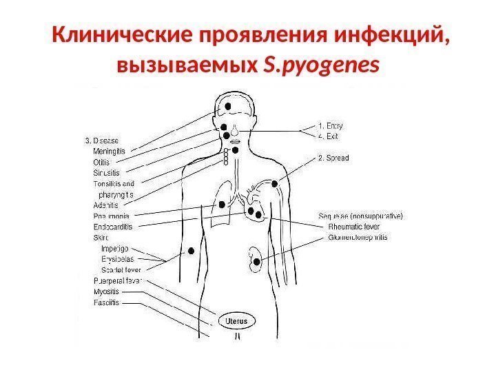  Клинические проявления инфекций,  вызываемых S. pyogenes 