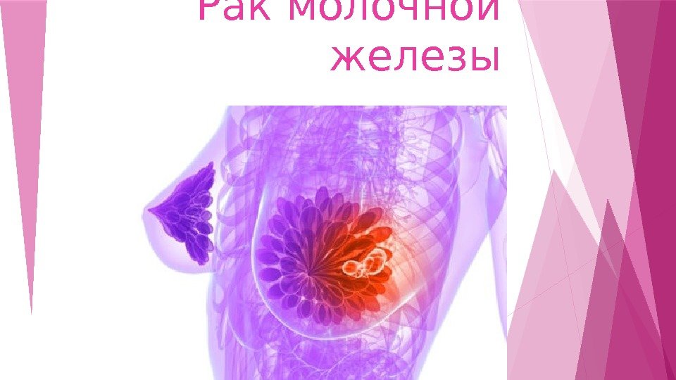 Рак молочной железы    
