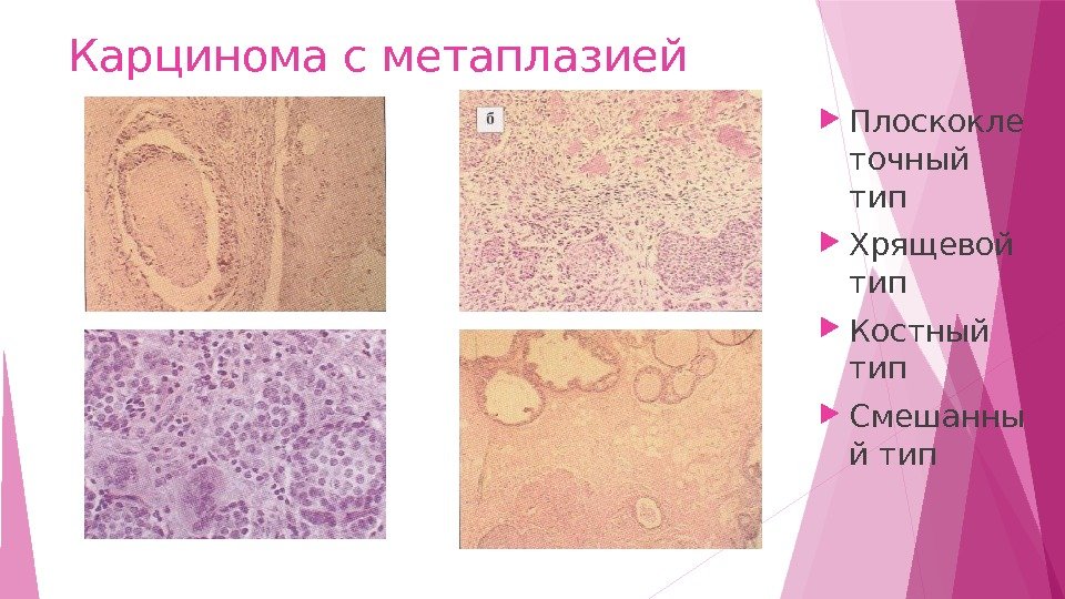 Карцинома с метаплазией Плоскокле точный тип  Хрящевой тип  Костный тип  Смешанны