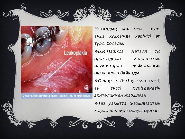 Металдың жағымсыз әсері ауыз қуысында көрінісі әр түрлі болады.  Б. М. Пашков металл