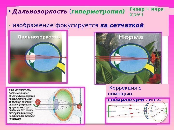  •  Дальнозоркость ( гиперметропия)  - изображение фокусируется за сетчаткой  Коррекция