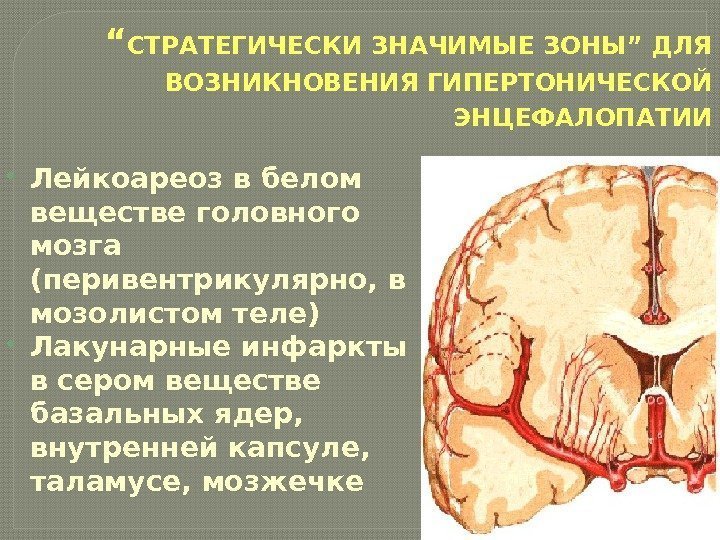 “ СТРАТЕГИЧЕСКИ ЗНАЧИМЫЕ ЗОНЫ” ДЛЯ ВОЗНИКНОВЕНИЯ ГИПЕРТОНИЧЕСКОЙ ЭНЦЕФАЛОПАТИИ Лейкоареоз в белом веществе головного мозга