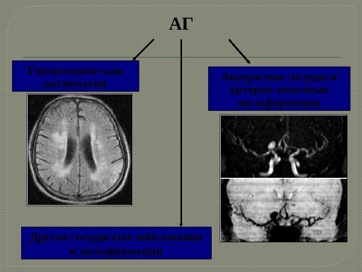 Гипертоническая ангиопатия А невризмы сосудов и  артерио-венозные мальформации Д ругие сосудистые заболевания и
