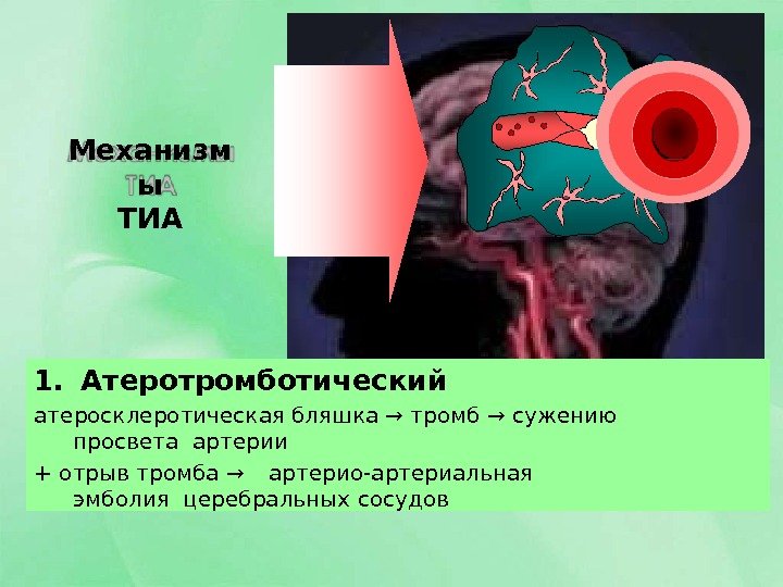Механизм ы ТИА 1. Атеротромботический атеросклеротическая бляшка → тромб → сужению  просвета артерии