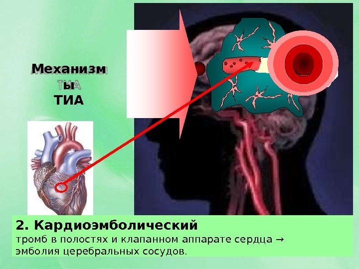 2.  Кардиоэмболический тромб в полостях и клапанном аппарате сердца  → эмболия церебральных