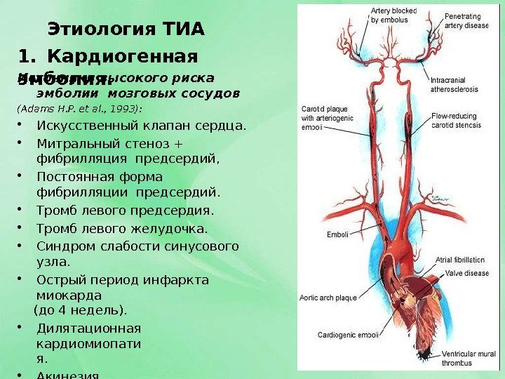 Этиология  ТИА 1. Кардиогенная  эмболия. Источники высокого риска  эмболии мозговых 