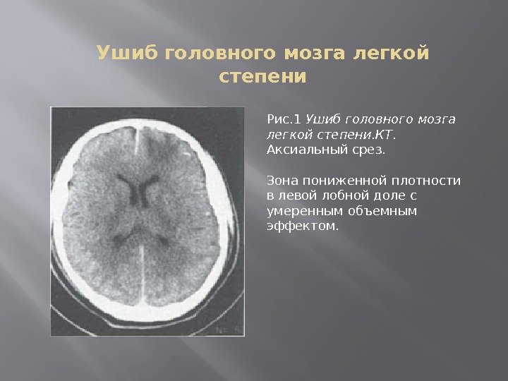 Ушиб головного мозга легкой степени Рис. 1 Ушиб головного мозга легкой степени. КТ. 