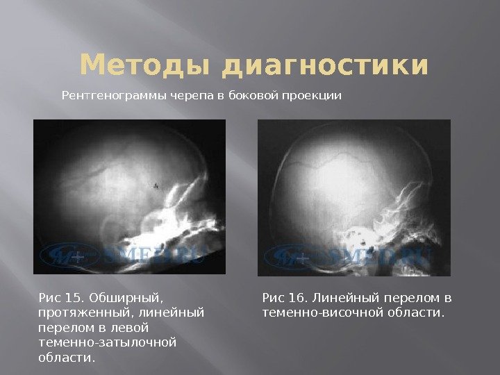 Методы диагностики Рентгенограммы черепа в боковой проекции Рис 15. Обширный,  протяженный, линейный перелом