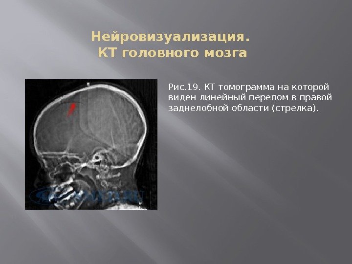 Нейровизуализация.  КТ головного мозга Рис. 19. КТ томограмма на которой виден линейный перелом