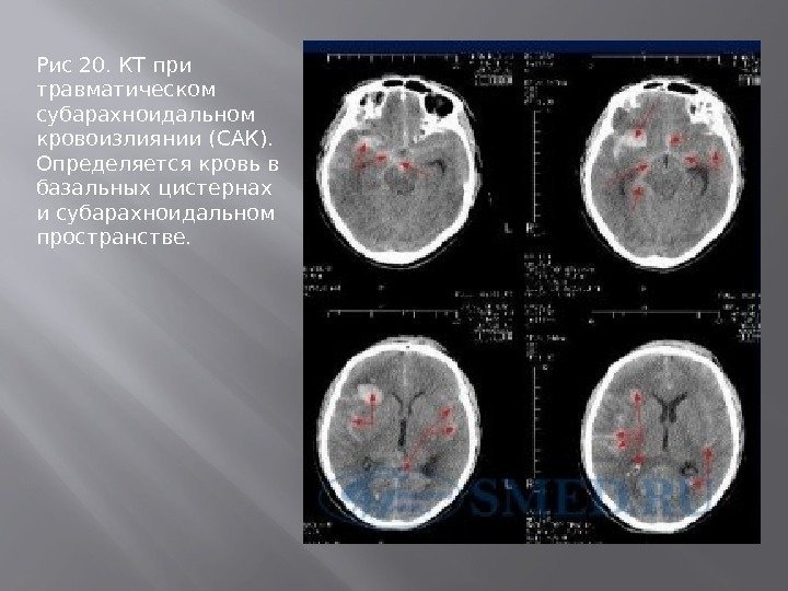 Рис 20. КТ при травматическом субарахноидальном кровоизлиянии (САК).  Определяется кровь в базальных цистернах