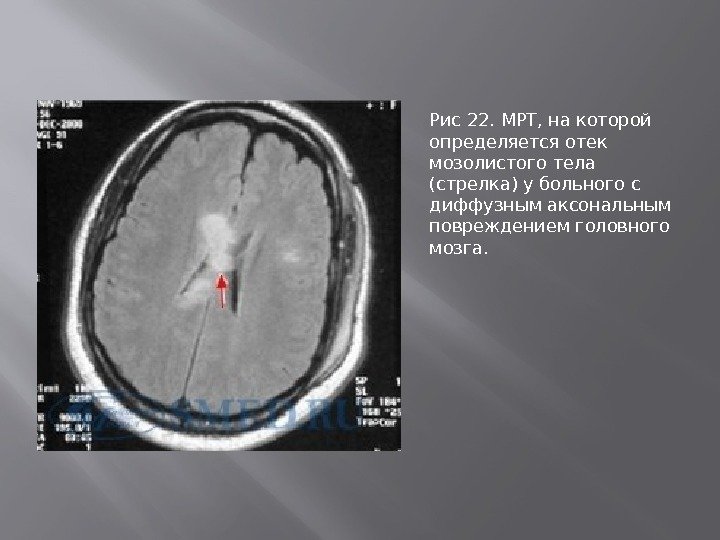 Рис 22. МРТ, на которой определяется отек мозолистого тела (стрелка) у больного с диффузным