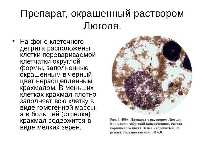 Препарат, окрашенный раствором Люголя.  • На фоне клеточного детрита расположены клетки перевариваемой клетчатки