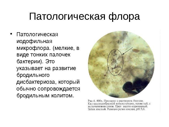 Патологическая флора • Патологическая иодофильная микрофлора. (мелкие, в виде тонких палочек бактерии). Это указывает