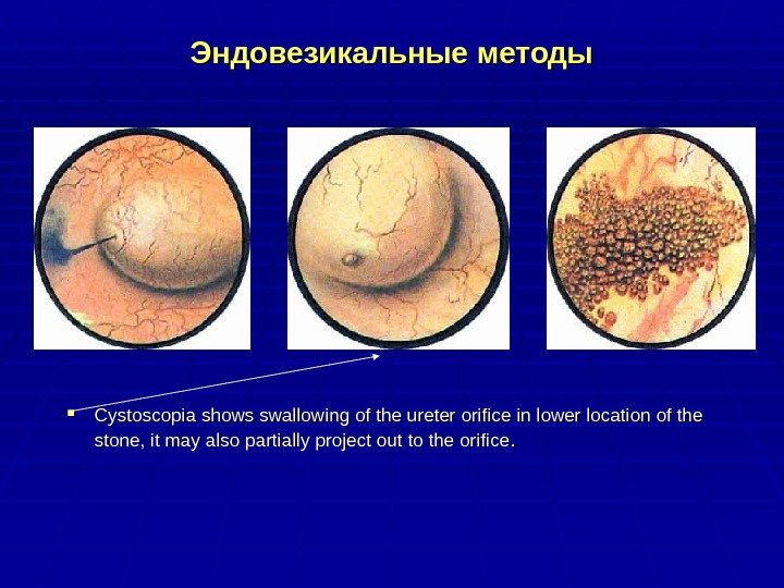 Эндовезикальные методы CC ystoscopia shows swallowing of the ureter orifice in lower location of