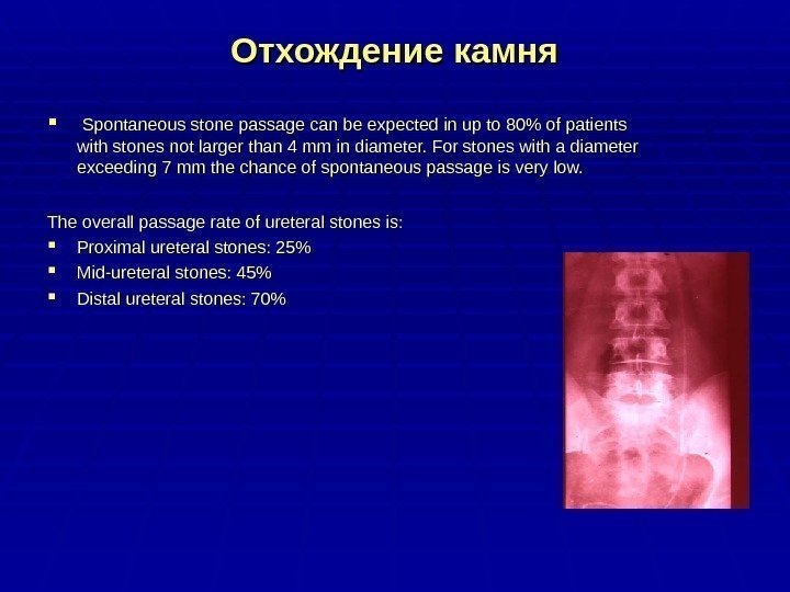 Отхождение камня Spontaneous stone passage can be expected in up to 80 of patients
