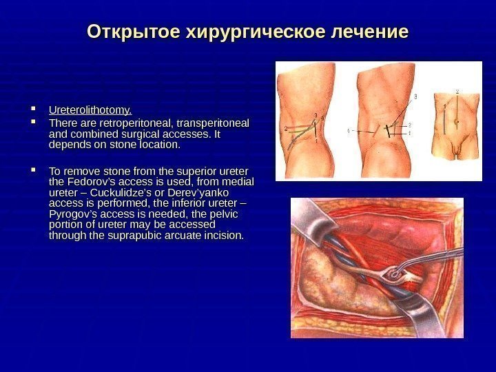Открытое хирургическое лечение Ureterolithotomy. There are retroperitoneal, transperitoneal and combined surgical accesses. It depends