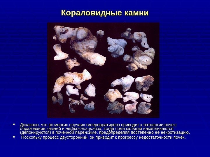 Кораловидные камни Доказано, что во многих случаях гиперпаратиреоз приводит к патологии почек:  образование