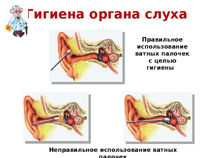 Гигиена органа слуха Правильное использование ватных палочек с целью гигиены  Неправильное использование ватных