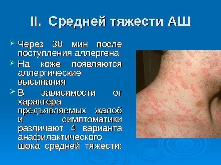 ІІ. Средней тяжести АШ  Через 30 мин после поступления аллергена На коже появляются аллергические