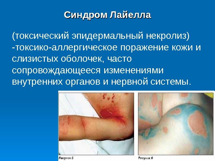 Синдром Лайелла (токсический эпидермальный некролиз) - токсико-аллергическое поражение кожи и слизистых оболочек, часто сопровождающееся