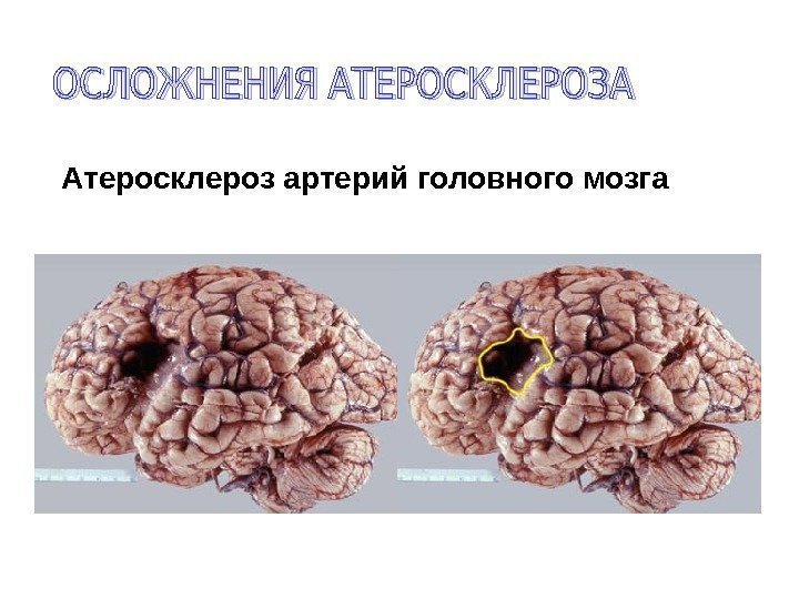 Атеросклероз артерий головного мозга 