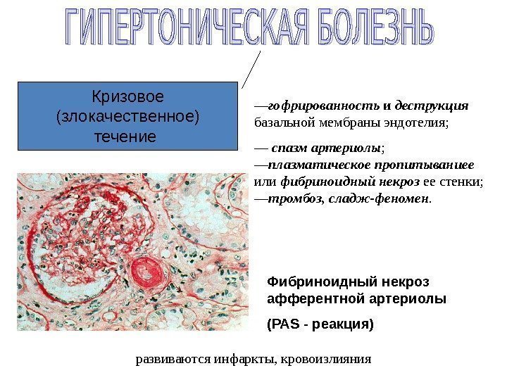 Кризово е  (злокачественное) течение Фибриноидный некроз афферентной артериолы ( PAS - реакция )—