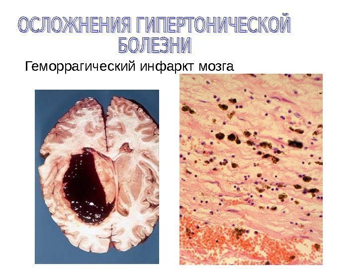 Геморрагический инфаркт мозга  