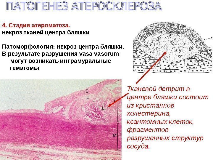 4. Стадия атероматоза. некроз тканей центра бляшки  Патоморфология: некроз центра бляшки. В результате