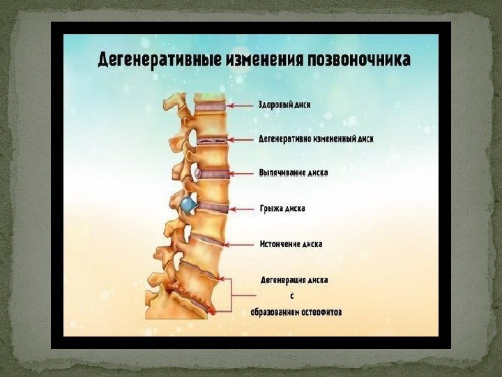 Дегенеративные изменения шейного позвоночника. Дегенеративно деструктивные заболевания позвоночника. Дегенеративно дистрофические изменения грудного отд позвоночника. Генеративное изменение позвоночника. Дистрофические изменения шейного позвоночника.