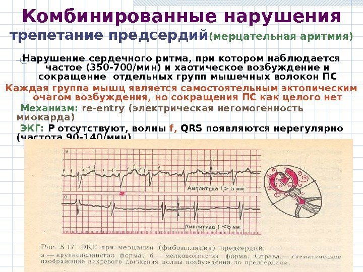 Комбинированные нарушения трепетание предсердий (мерцательная аритмия) Нарушение сердечного ритма, при котором наблюдается частое (350