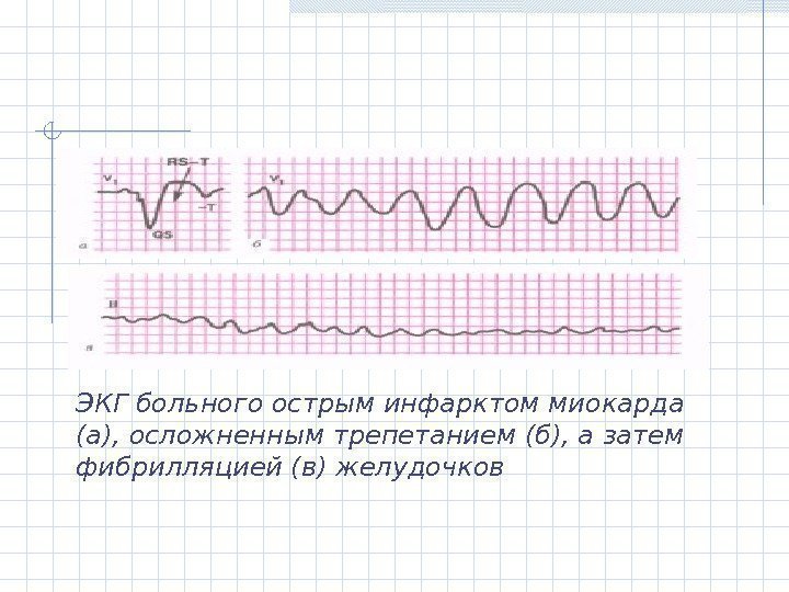 ЭКГ больного острым инфарктом миокарда (а), ос ложненным трепетанием (б), а затем фибрилляцией (в)