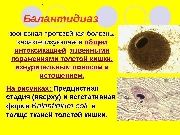   Балантидиаз  зоонозная протозойная болезнь,  характеризующаяся общей интоксикацией ,  язвенными