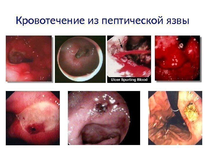 Кровотечение из пептической язвы 