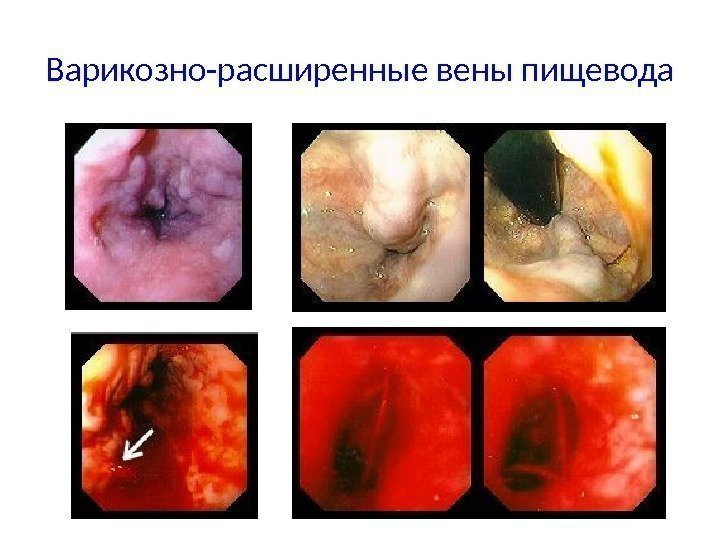 Варикозно-расширенные вены пищевода 