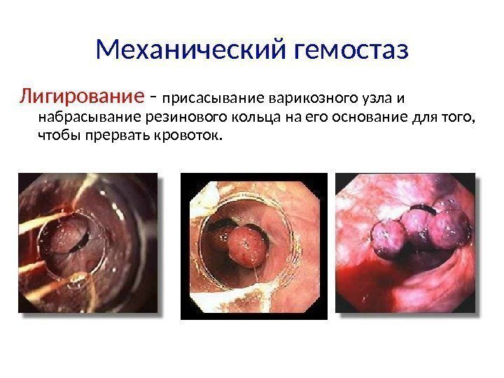 Механический гемостаз Лигирование - присасывание варикозного узла и набрасывание резинового кольца на его основание