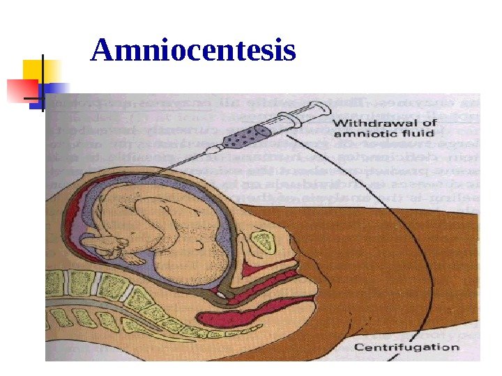   Amniocentesis 