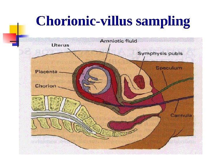  Chorionic-villus sampling 