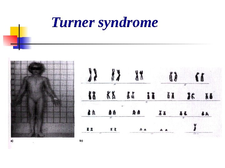   Turner syndrome 