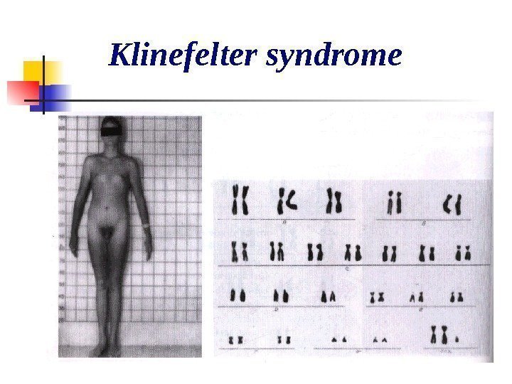   Klinefelter syndrome 
