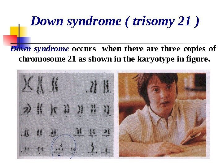   Down syndrome ( trisomy 21 ) Down syndrome  occurs  when