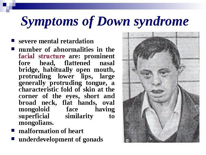  Symptoms of Down syndrome  severe mental retardation number of abnormalities in