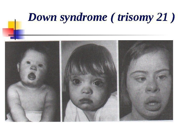   Down syndrome ( trisomy 21 ) 