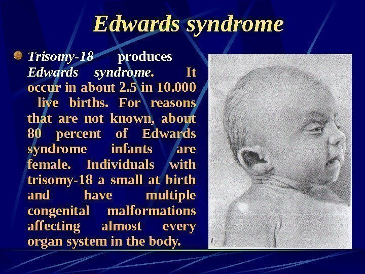   Edwards syndrome Trisomy-18  produces  Edwards syndrome. It occur in about