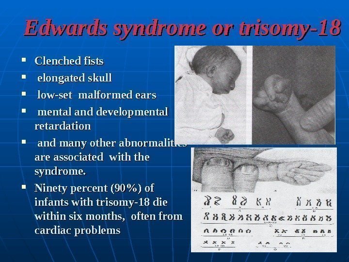 Edwards syndrome or trisomy-18 Clenched fists elongated skull low-set malformed ears mental and