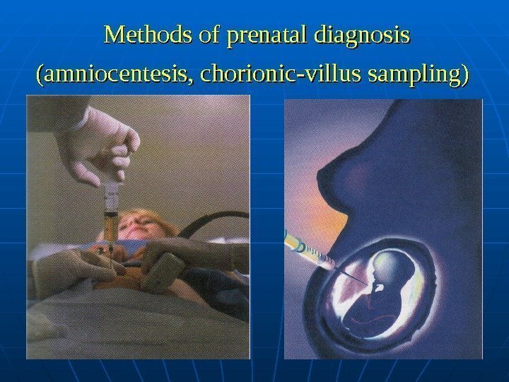  Methods of prenatal diagnosis (amniocentesis, chorionic-villus sampling)  