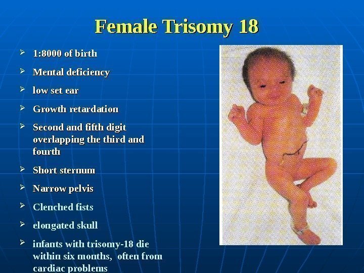  Female Trisomy 18 1: 8000 of birth Mental deficiency low set ear Growth