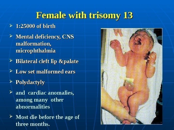 Female with trisomy 13 1: 25000 of birth Mental deficiency, CNS malformation, microphthalmia