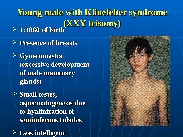  Young male with Klinefelter syndrome (XXY trisomy) 1: 1080 of birth Presence of