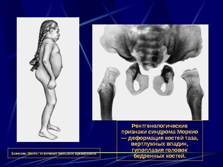   Болезнь Шейе: типичные внешние проявления Рентгенологические признаки синдрома Моркио — деформация костей